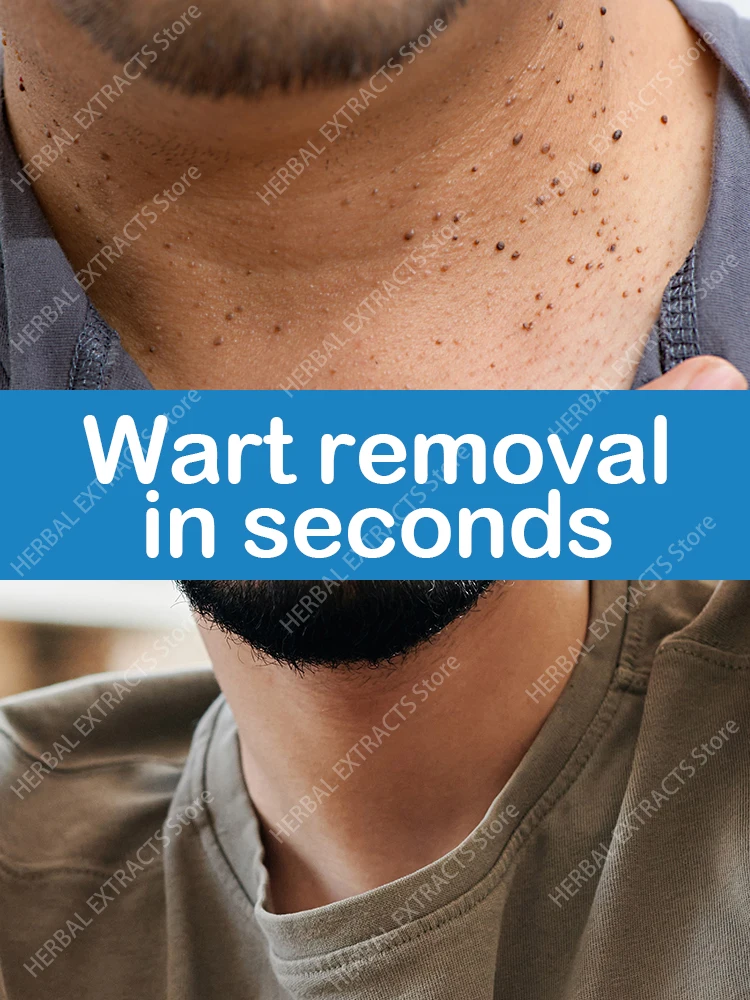 

Мазь для удаления бородавок, бородавок, бородавок