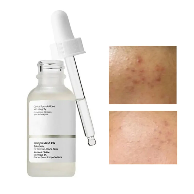 30mL Salicylic Acid 2% Solution Acne Spot Removing Tighten Pores Facial Essence For Blemish Prone Skin