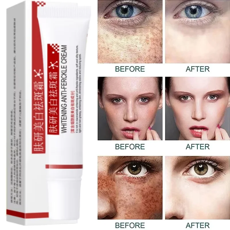 20 г темных пятен различные пятна указывающие темные отбеливающий кожу