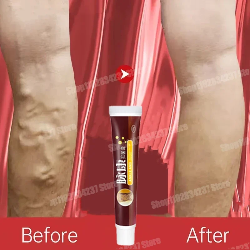 Крем для лечения варикозного расширения вен удаление красных пятен крови