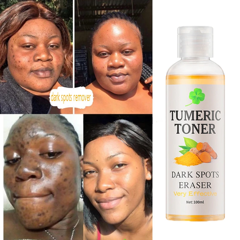 

100ml Tumeric Dark Spots Toner Spots Eraser Corrector Turmeric Fade Blemishes Dark Spot Remover Acne Remover Toner for Dark Skin