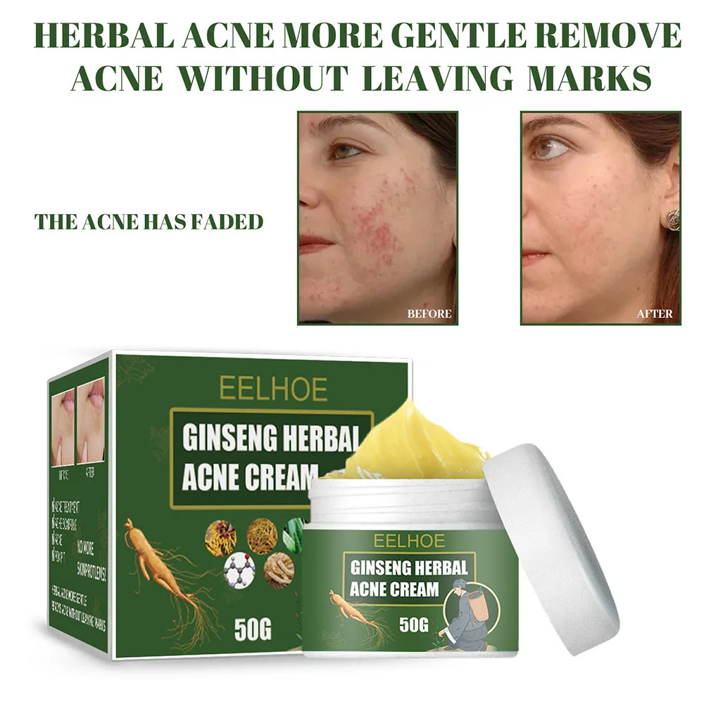 

Effective Acne Removal Cream Treatment Acne Scar Shrink Pores Oil Control Whitening Moisturize Face Ginseng Herb Acne Skin Care