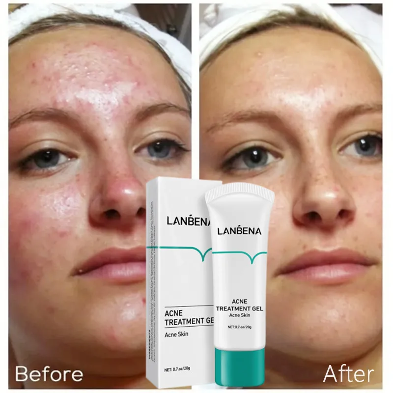 

LANBENA Acne Treatment Gel Remove Acne Pimples Anti-ance Shrink Pores Anti-inflammatory Soothing Improve Roughness Skin Care 20g