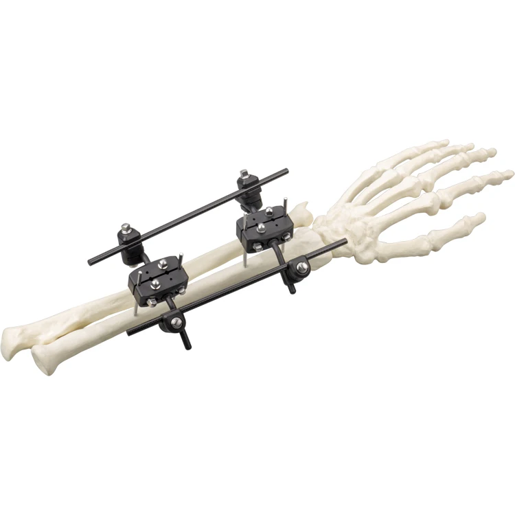 

External fixation orthopedic of radius backbone frame enternal fixation system