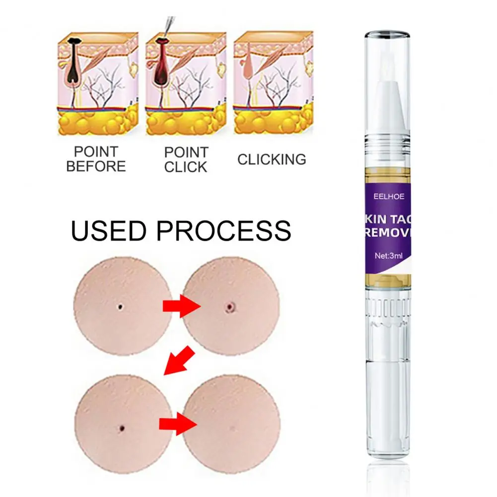 

Функциональная жидкость для удаления бородавок, безболезненная ручка для бородавок с веснушками, портативное глубокое удаление морщин с г...