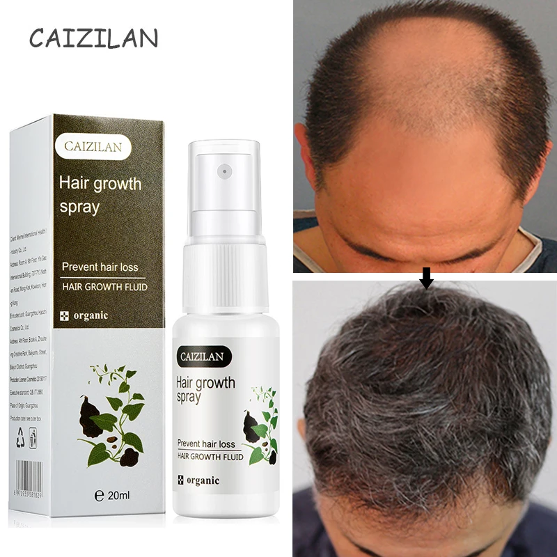 

20ml Hair Growth Spray Serum Ginger Treatment Hair Loss Essence Fast Growing Nourishing Soften Scalp Repair Damaged Hair Care