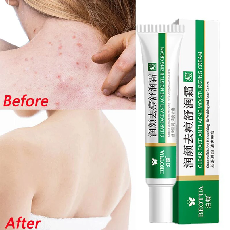 

Herbal Acne Remove Cream Treatment Face Back Buttocks Acne Body Cream Fade Acne Marks Oil Control Whitening Skin Care Products