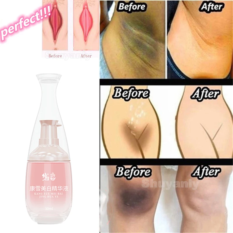 

Эссенция для отбеливания женской влагалища, Отбеливающее средство для отбеливания кожи, для рук, подмышек, локтей, колен, тела, для скучного ...