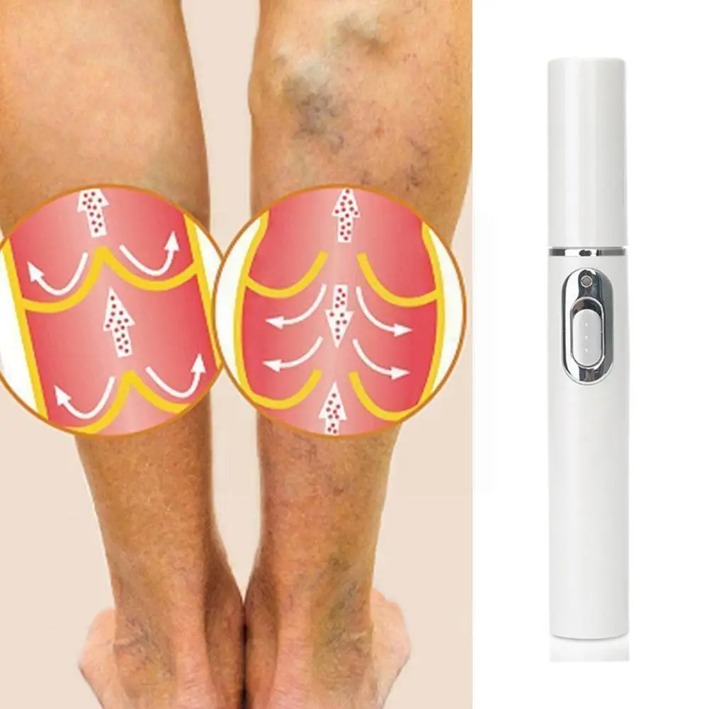 

1pc Medical Blue Light Therapy Pen Varicose Veins Treatment Removal Treatment Scar Soft Acne Scar G9e3