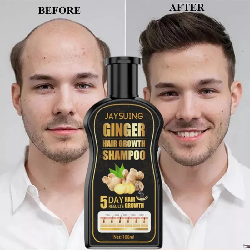 

Товары для роста волос Sdotter 100 мл, имбирный быстрорастущий шампунь на 5 дней, косметический уход за волосами, предотвращение выпадения волос, ...