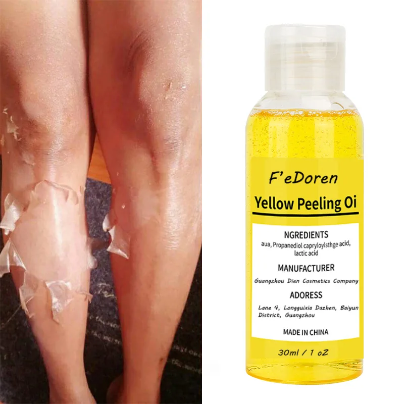 

Yellow Peeling Oil Bleaching Dark Super Strength Extra Strength Exfoliating Bleaching Dark Skin Blackhead Exfoliating Lightening