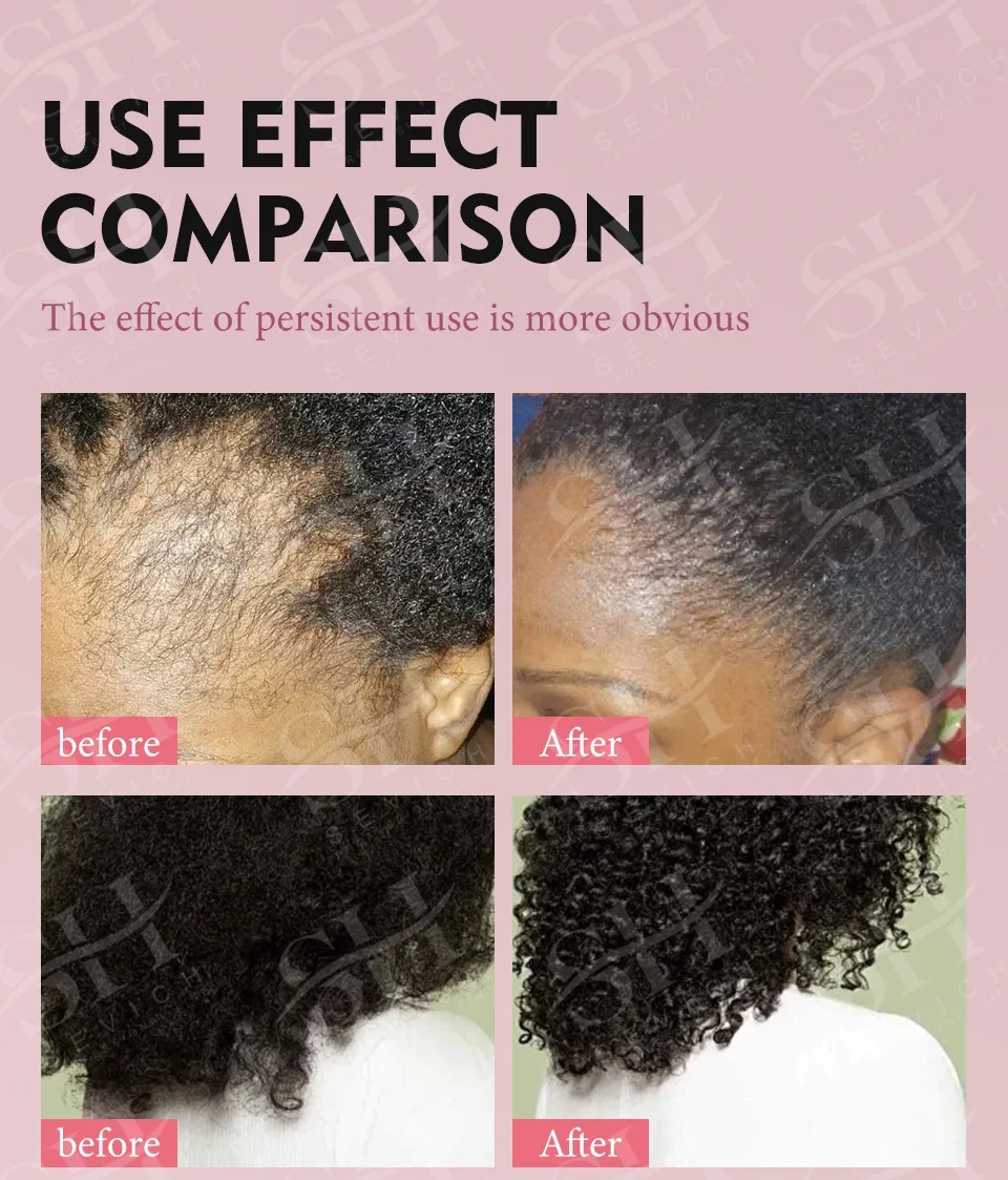 100% натуральное масло Karkar розмарина для роста волос укрепления сыворотка мужчин и