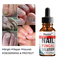 nail fungus treatment essence serum care hand and foot care removal repair gel anti infective paronychia onychomycosis