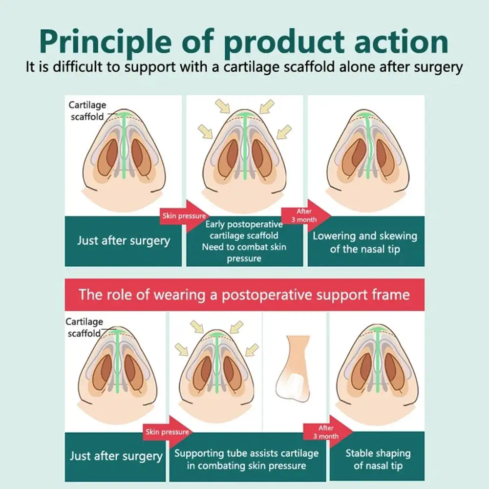 Устройство для поддержки ноздрей после комплексной коррекции и фиксации