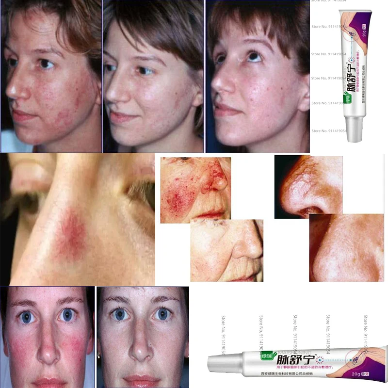 Крем от варикозного расширения вен на лице |