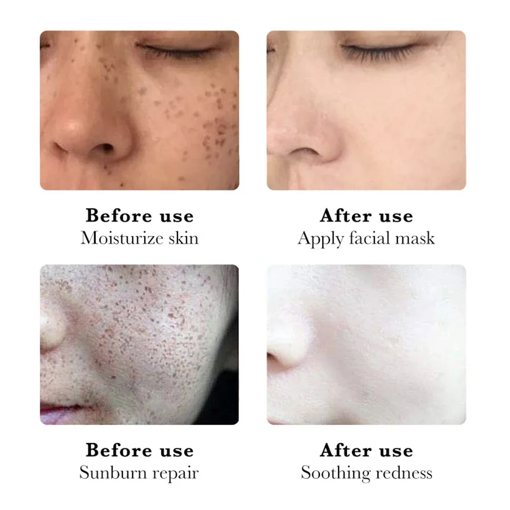 Отбеливающий крем от мелазмы темных точек веснушек Осветляющий никотинамид