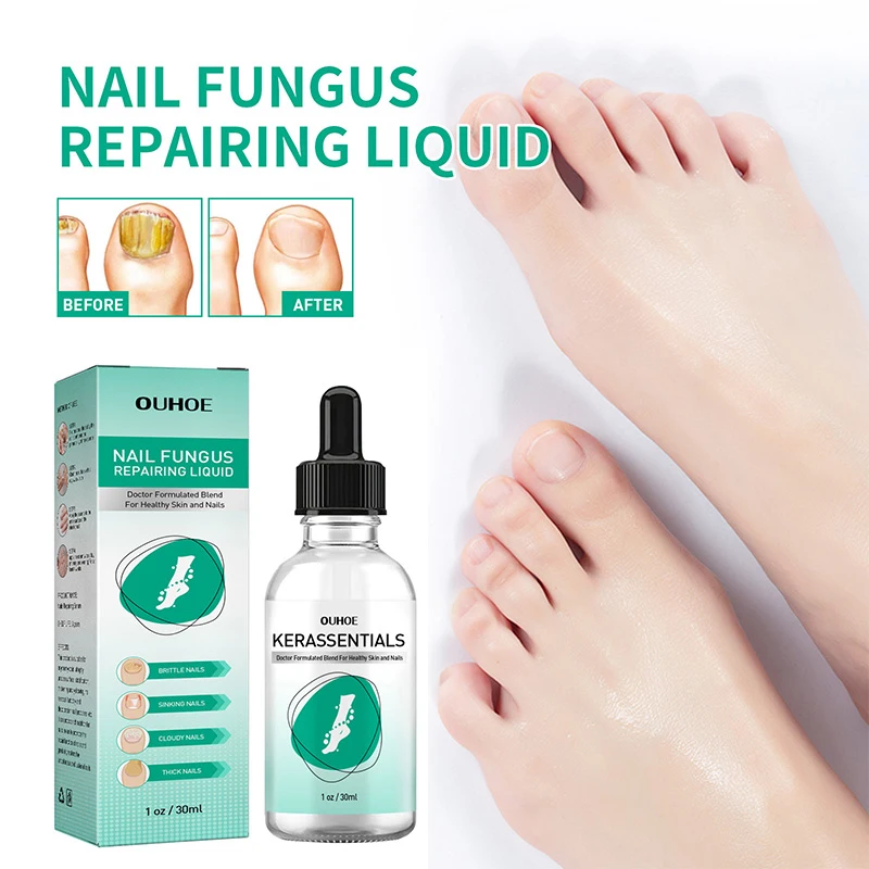 

Ingrown Toenail Treatment Serum Nail Correction Recover Oil Pain Reliever Nail Softener Trim With Ease Oil Feet Health Care Safe