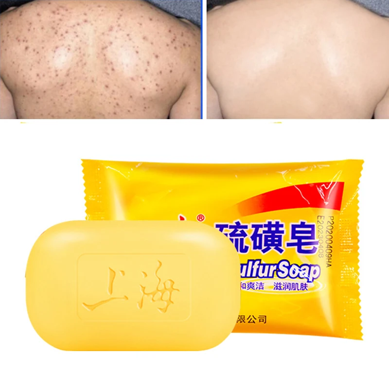 

Серное масло для лица, от экземы, экземы, противогрибка, 85 г