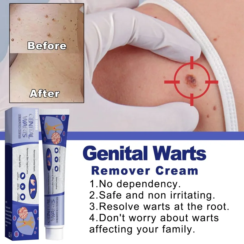 

Wart Treatment Cream Warts Removal Antibacterial Ointment Remove Skin Tag Foot Corn Mole Acne Herbal Medical Plaster 20g