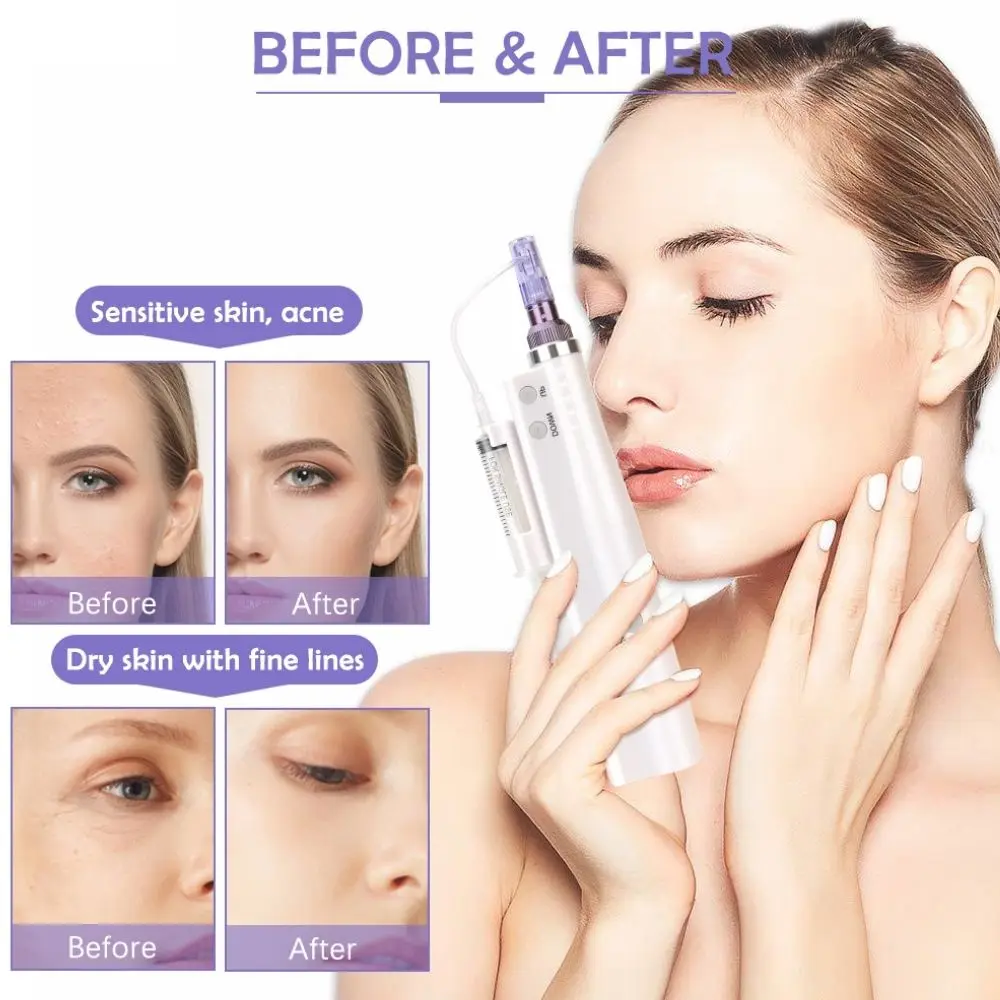 Рисунок 3 - шприцевые иглы для мезотерапии