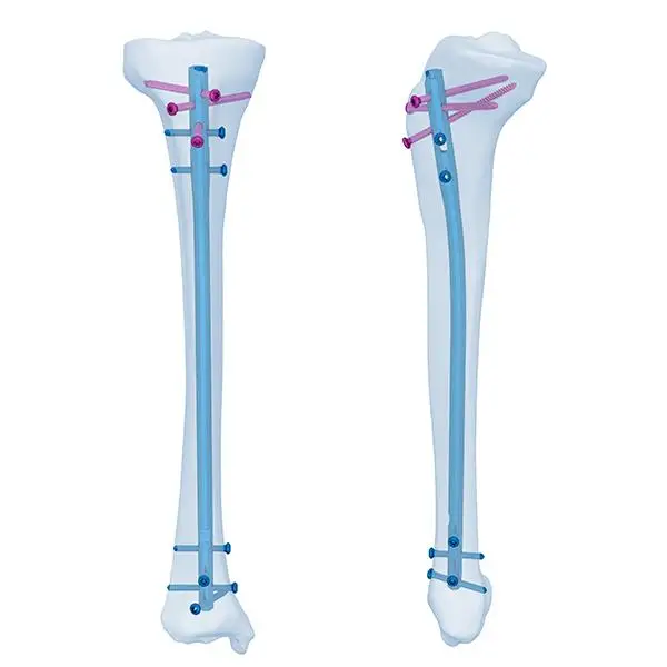 

Ортопедический хирургический тибиальный имплантат для кости Meditech, сертификация CE и ISO, эксперт по взаимной связке тибии, Интрамедуллярный ноготь