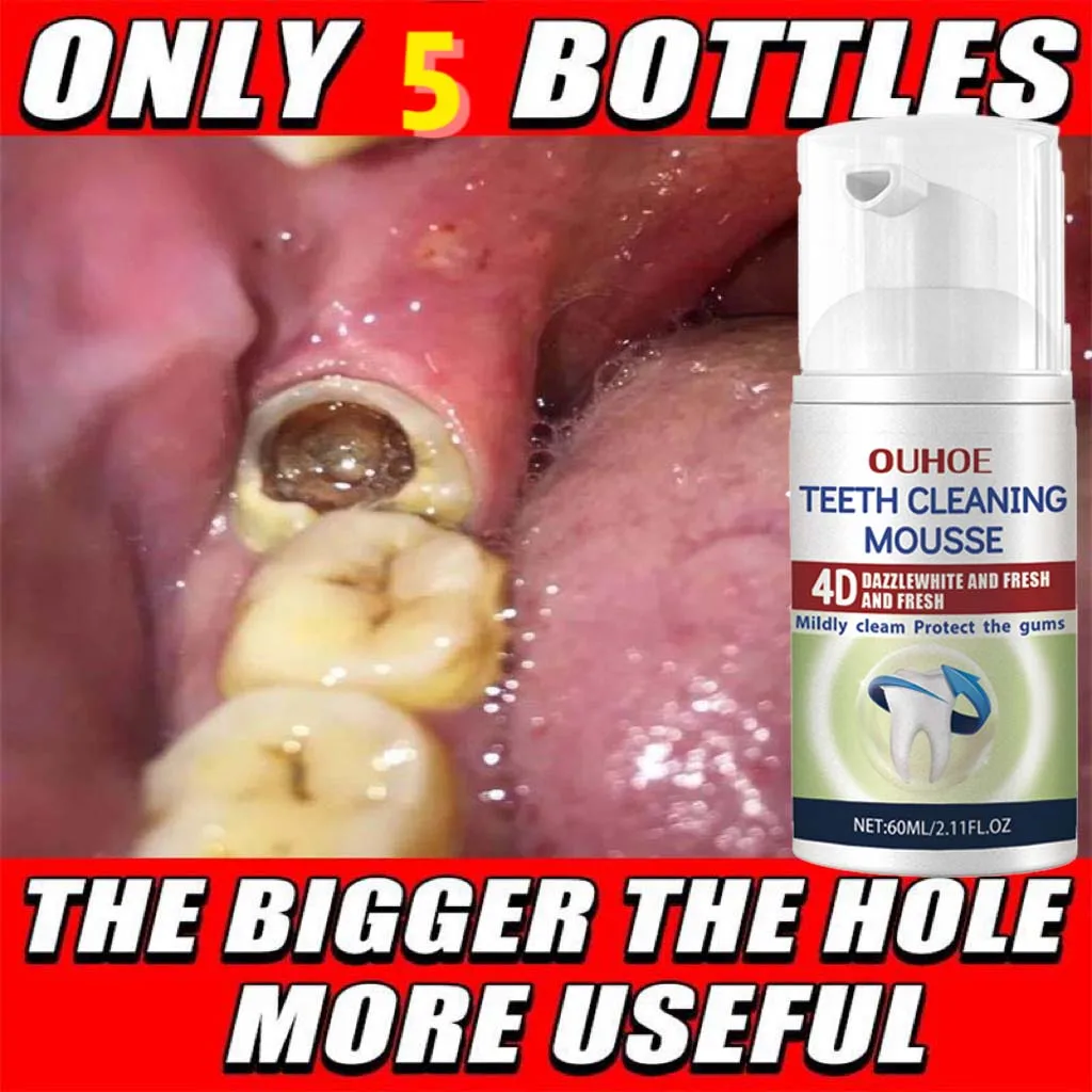 

Instant Anti-cavity Tooth Mousse Decay Fresh Breath Repair Tooth Decay Remove Plaque Toothache Relieve Periodontitis Teeth Care