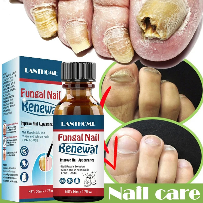 

Fungal Nail Treatment Serum Onychomycosis Paronychia Anti-Fungal Nail Infection Herbal Toe Fungus Foot Repair Essence Care 50ml
