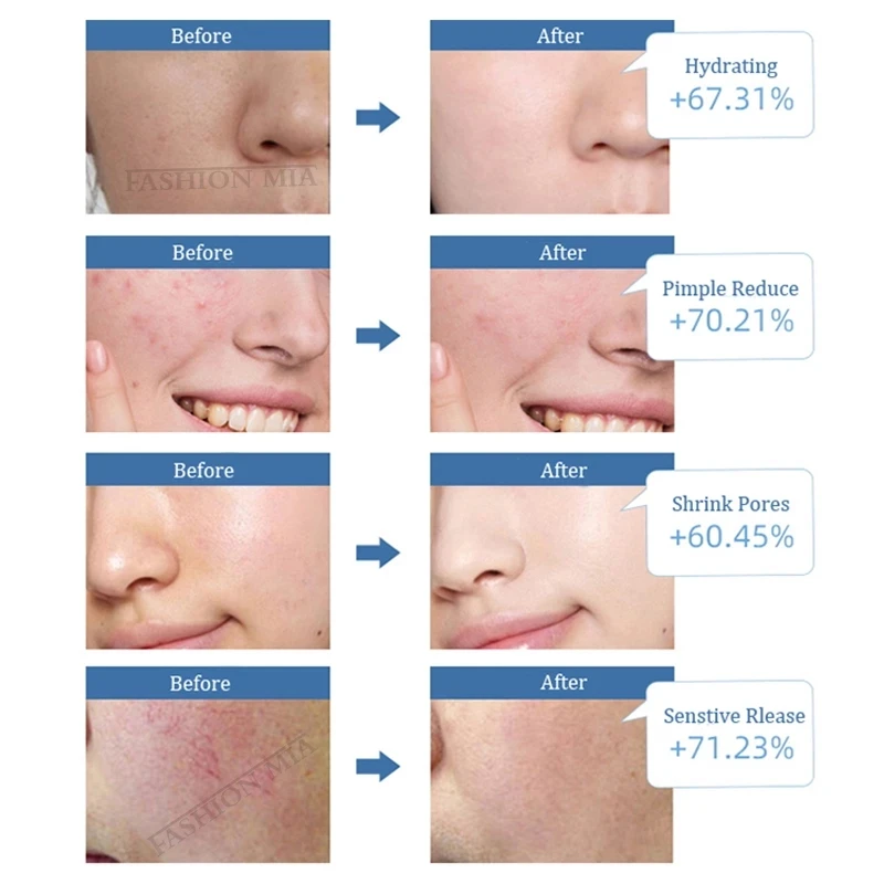 100% немецкий дермароллер Гиалуроновая кислота против старения отбеливание