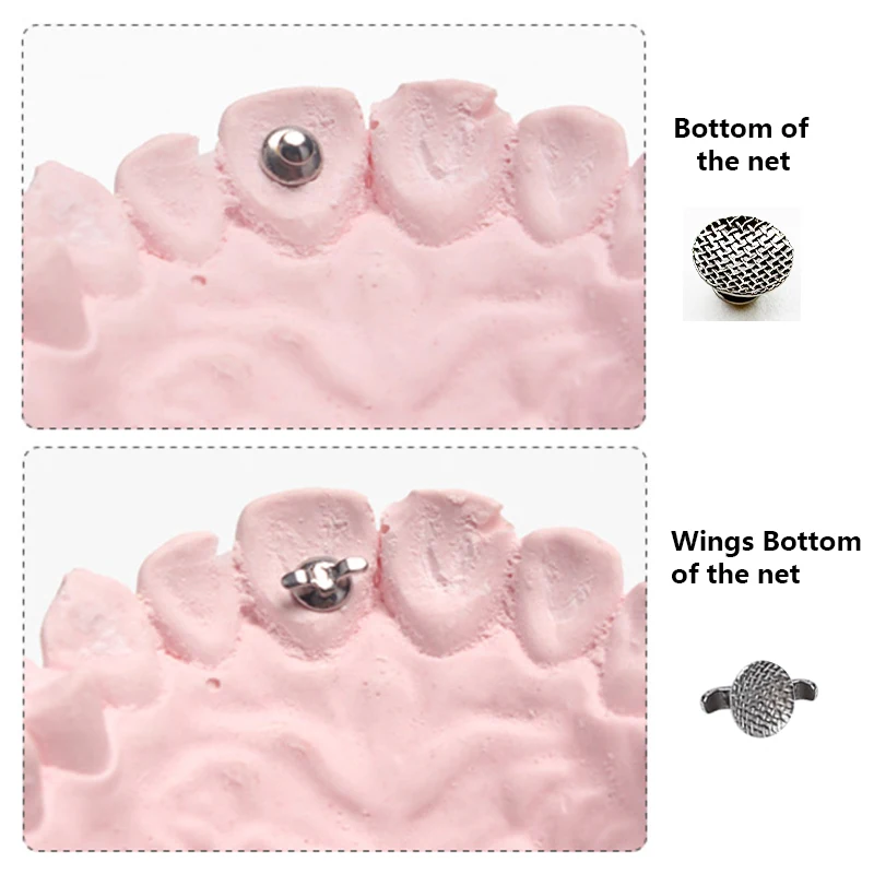 ± шт./упак. лыжный ортодонтия нижняя часть сетки/крылья ортодонтическая кнопка на