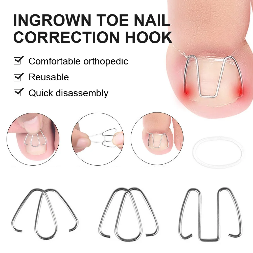 

3Pairs Toe Nail Correction Hook Front Nail Hook With 30Pcs Rubber Bands Nail Ingrown Clip Orthosis Nail Care Paronychia Repair