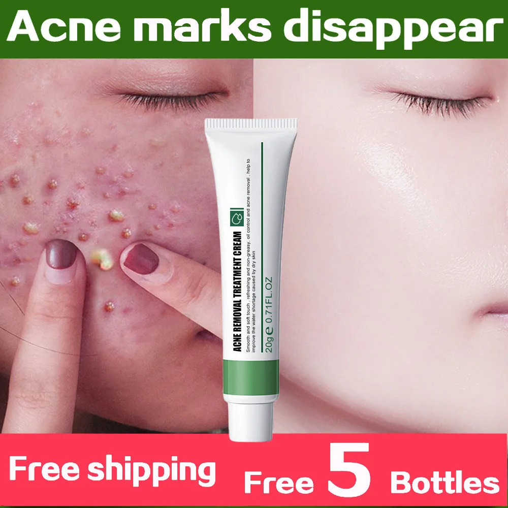 

Herbal Acne Treatment Cream Pimple Spot Removal for Teens Oil Control Acne Scar Gel Shrink Pores Face Skin Care Beauty Health