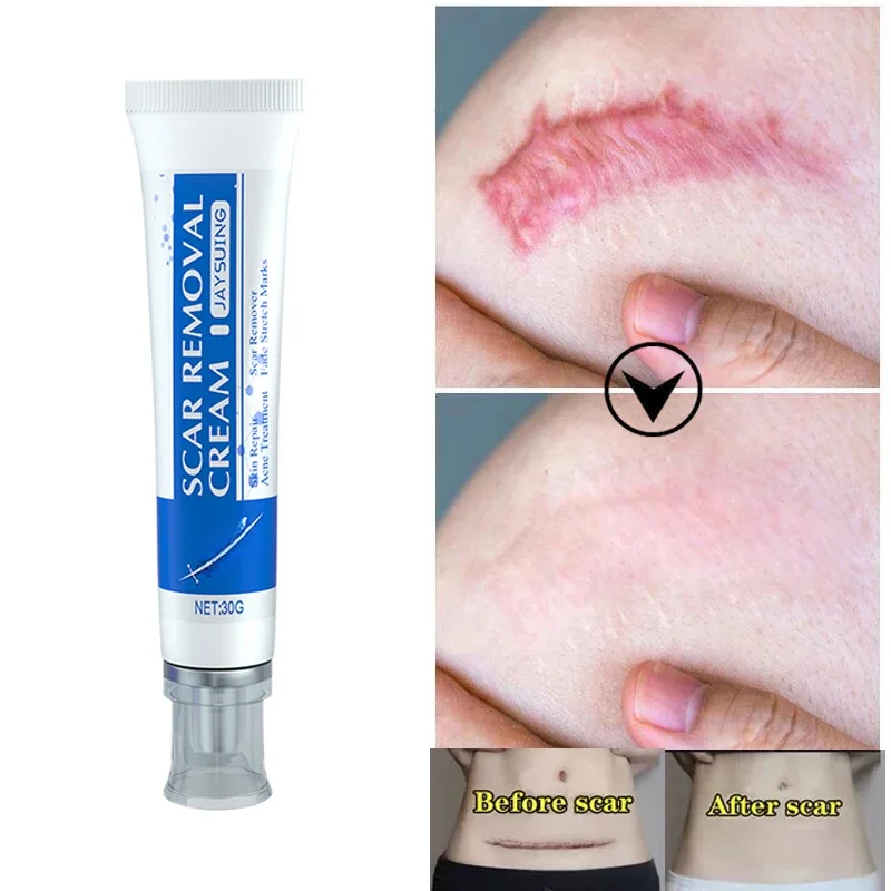 

Herbal Scar Removal Cream Stretch Marks Gel Repairing Pock Mark Burn Surgical Scar Cesarean Old Scars Smooth Moisturizing Skin