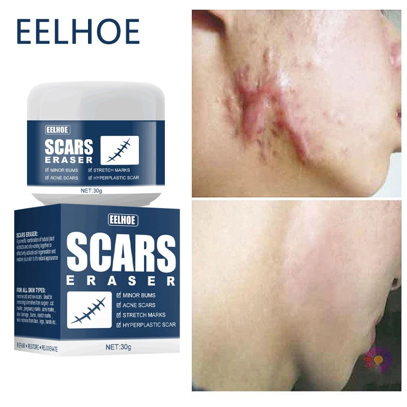 

Effective Acne Scar Removal Cream Pimples Stretch Marks Surgical Burn Scar Pigmentation Corrector Smoothing Whitening Body Care