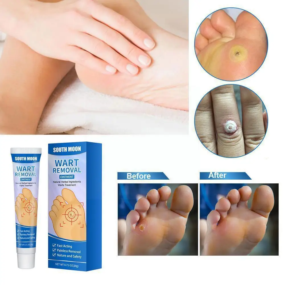 

20g Wart Removal Ointment Wart Therapy Cream Neck Skin Genitals Therapy Wart Cream Corns Tag Wart Wart Feet New Armpit Flat K8n7
