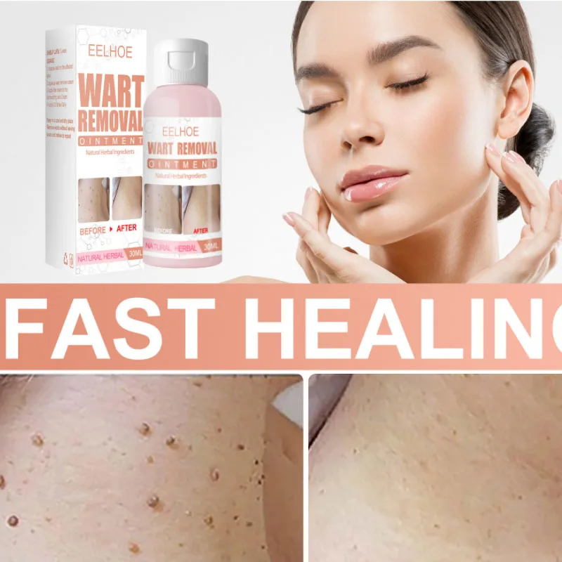 

Skin Tag Wart Remover Medical Cream Against Moles Removal Genital Wart Acne Spot Treatment Anti Foot Corn Skin Care Ointment