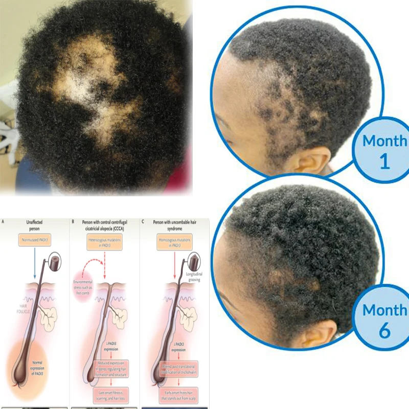 Cicatricial Alopecia 3 PCs Ancient Secret Recipe for Hair Growth Treatment Shampoo Wild Grow Hair Anti Hair Loss for Baldness