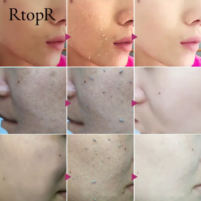 RtopR Facial Exfoliating Gel Cream Whitening Moisturizing Facial Scrub Clear Acne Blackhead Facial Scrub 3