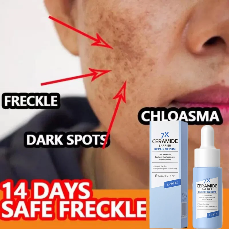 

Freckles Removal Serum Freckle Melanin Remover Dark Spot Corrector Anti Aging Niacinamide Whitening Brightening Beauty Face Care