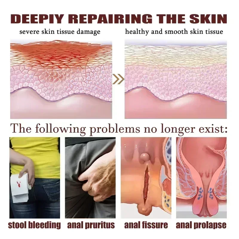 Мазь для удаления геморроя травяная снимает анальный набряк ануса лечебный гель