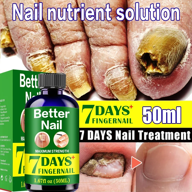 

50ml Nail Fungal Treatment Repair Essence Serum Paronychia Onychomycosis Anti Infection Care Foot Fungus Removal Gel