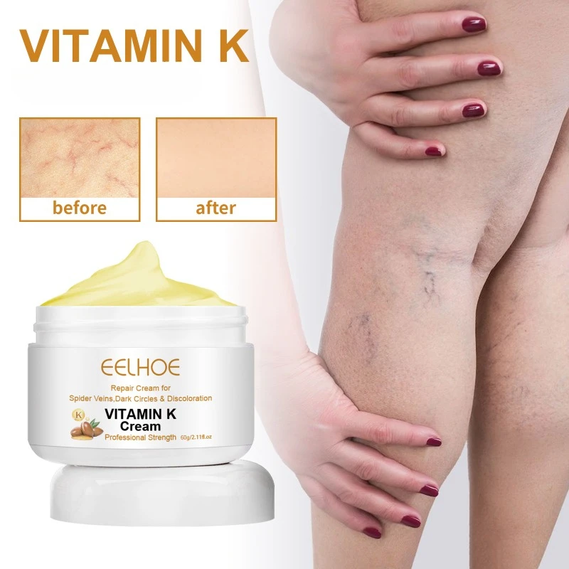 Крем с витамином K для лечения варикозного расширения вен флебит варикозное