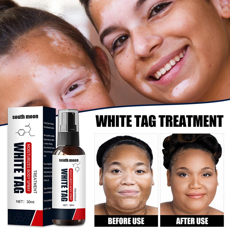 

30ml White Spot Remover Spray Leukoplakia Disease Melanin Skin Repair Cream