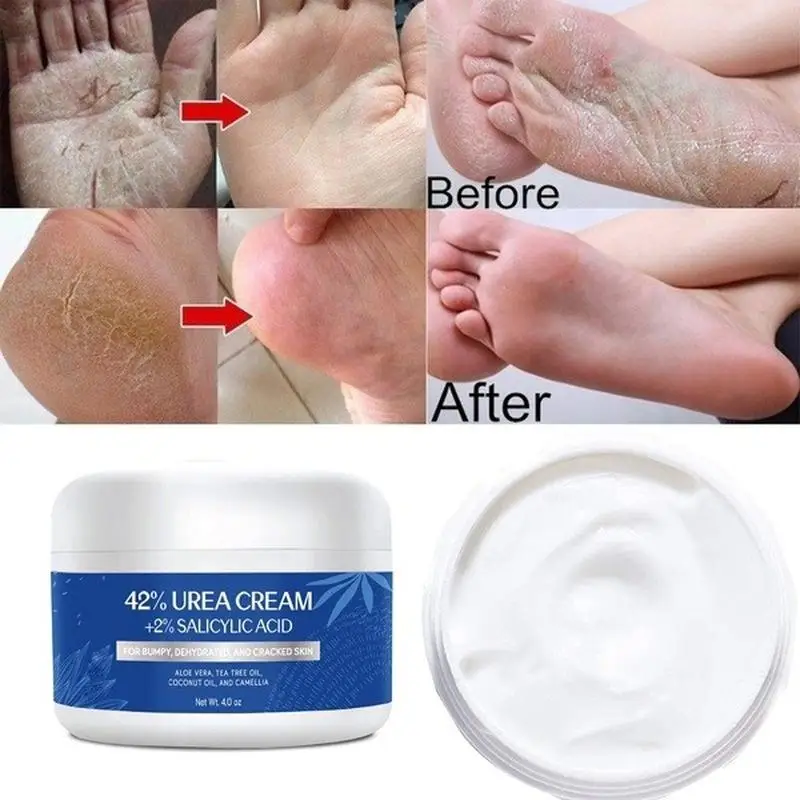 42% Plus Salicylic Acid 4 Oz, Upgraded Callus Remover Hand Cream Foot Cream For Dry Cracked Feet, Hands,