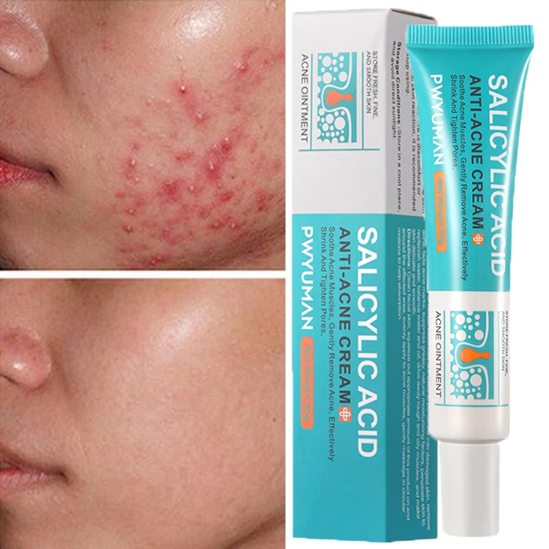 

Salicylic Acid Acne Removal Cream Face Treatment Moisturizing Oil Control Shrink Pore Repair Fade Redness Pimple Scar Skin Care
