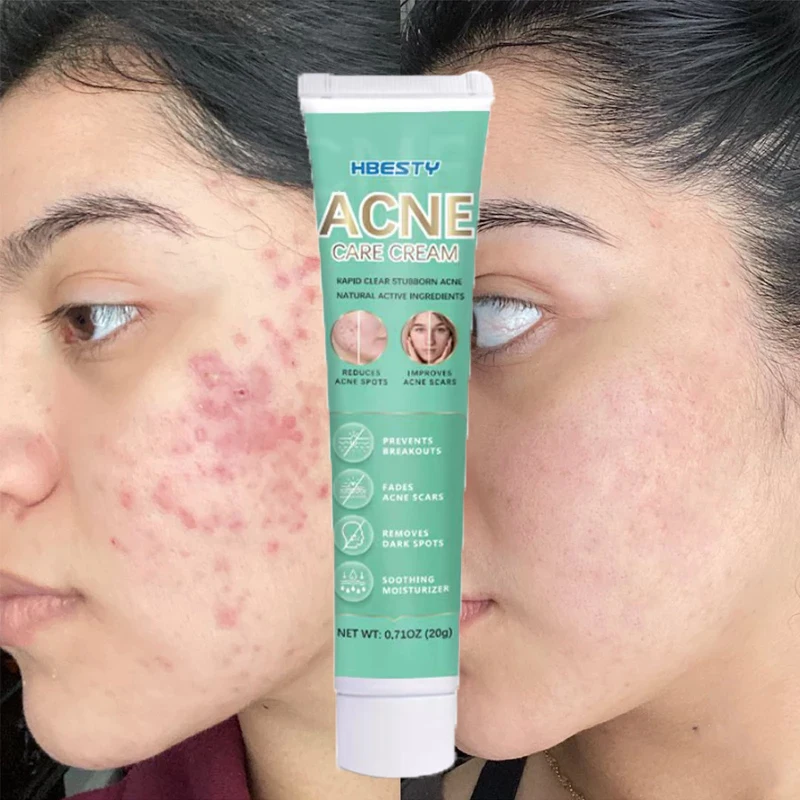

Acne Removal Treatment Acne Scar Gel Face Cream Moisturizing Oil Control Nourishing Brighten Facial Beauty Care Skin