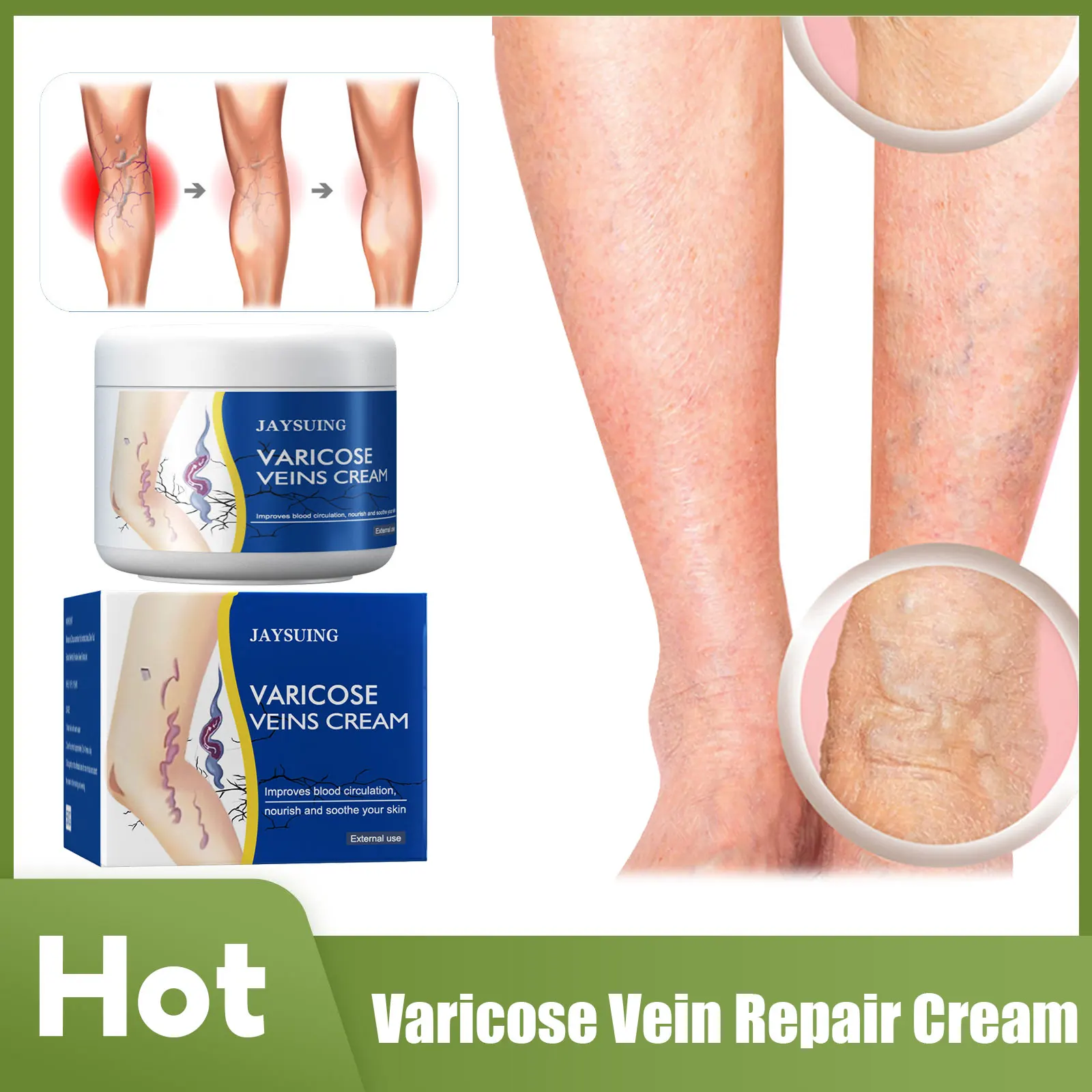 

Varicose Vein Repair Cream Leg Vasculitis Phlebitis Angiitis Spider Shape Veins Pain Swelling Effective Soothing Relief Ointment