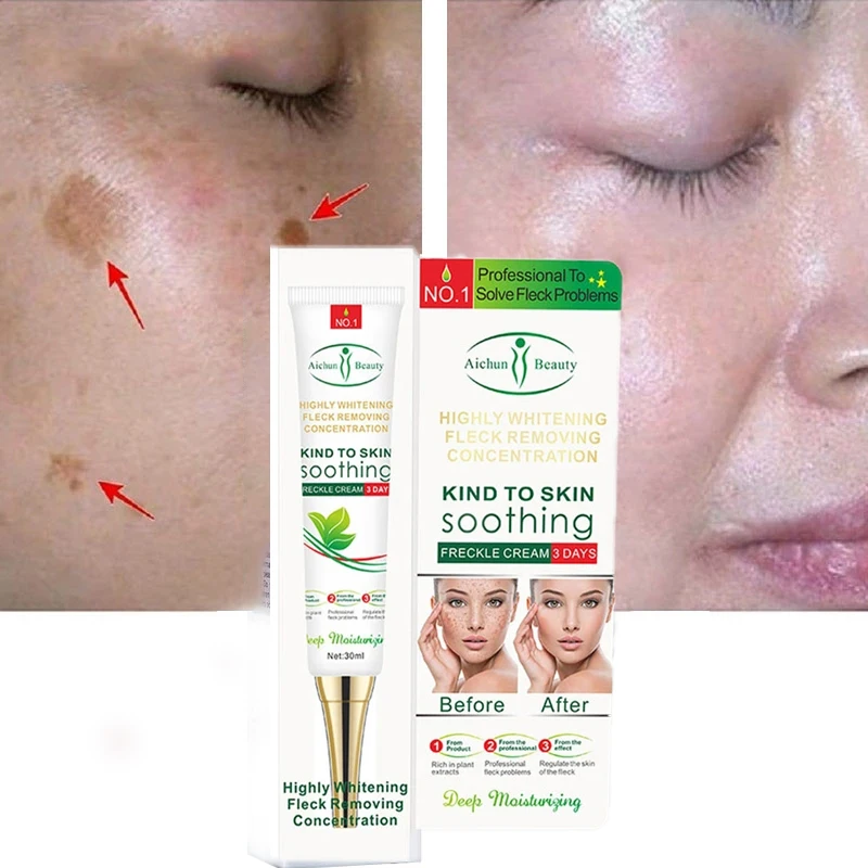 Whitening And Freckle Cream Effectively Removes Melasma Acne Dark Spot Pigment Melanin Facial Moisturizing Skin Care 30G