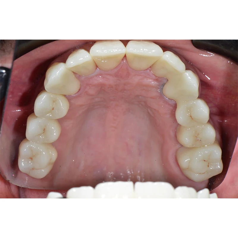 HaHasmile Циркониевые блоки для CADCAM 95*10/12/14/16/18/20/22/25 мм