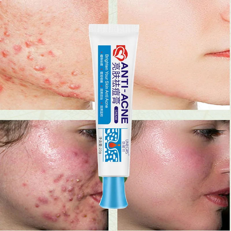 

Desalt ANTI-ACNE Removing Cream Security Warm Brighten skin Acne Gel Gel Oil Control and Nourishment Repair Damage 25g