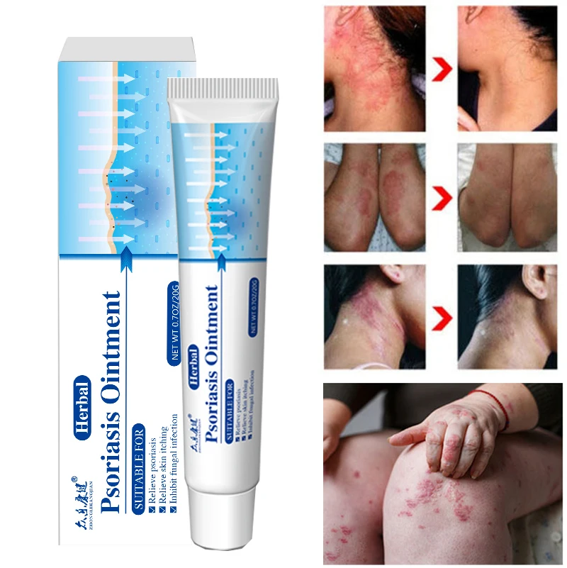 

Antibacterial Psoriasis Cream Ointment Herbal Anti-itch Relief Dermatitis Eczema Treatment Urticaria Desquamation Body Skin Care